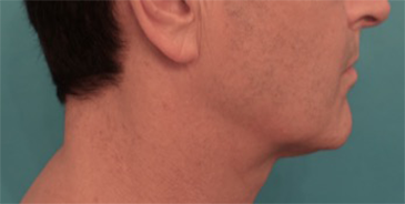 After Image: Male Kybella Patient #3 -