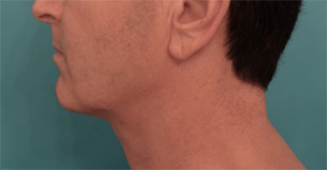 After Image: Male Kybella Patient #3 - 