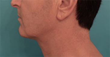 Male Kybella Patient #3 After Photo # 2