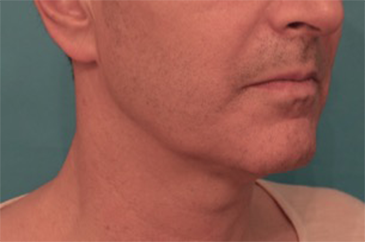 Kybella Patient #3 Before Photo # 7