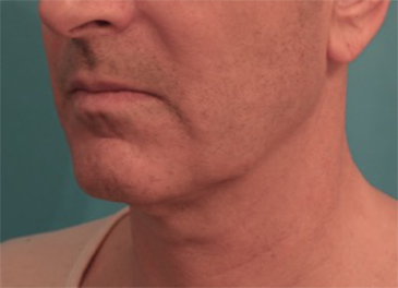 Kybella Patient #3 Before Photo # 5