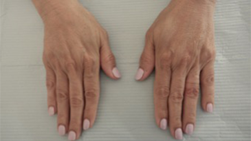 Dermal Fillers (Hand) Patient #1 After Photo # 2