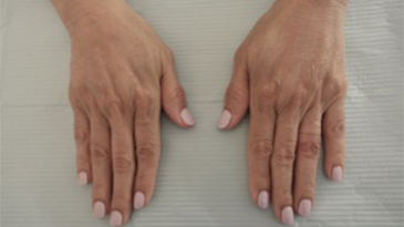 Dermal Fillers (Hand) Patient