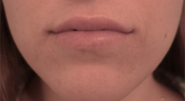 Lip Filler Patient #8 After Photo Thumbnail # 2