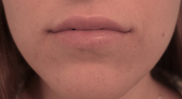 Lip Filler Patient