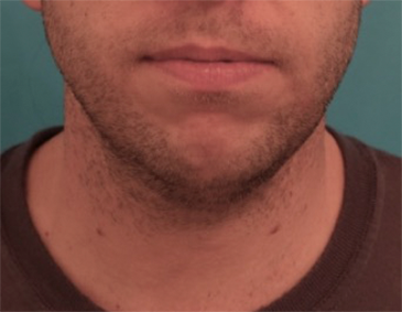 Male Kybella Patient #2 Before Photo # 1