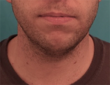 Before Image: Male Kybella Patient #2 - 