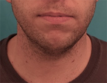 Male Kybella Patient