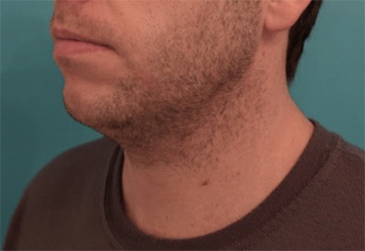 Male Kybella Patient #2 Before Photo # 3