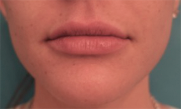 Lip Filler Patient #7 After Photo # 2