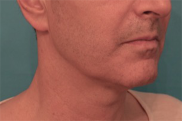 Before Image: Male Kybella Patient #3 -