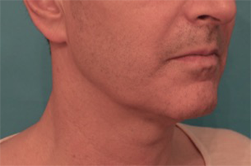 Male Kybella Patient #3 Before Photo # 7