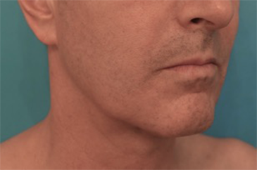 Male Kybella Patient #3 After Photo Thumbnail # 8