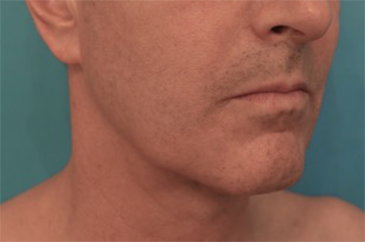 After Image: Male Kybella Patient #3 -