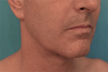 Male Kybella Patient #3 After Photo # 8