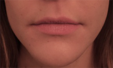 Lip Filler Patient #7 Before Photo # 1