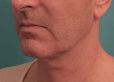 Before Image: Male Kybella Patient #3 -
