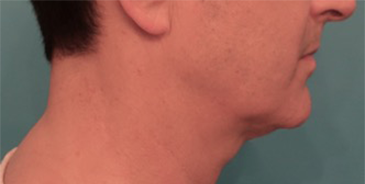 Kybella Patient #3 Before Photo # 3