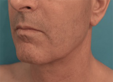 After Image: Male Kybella Patient #3 -