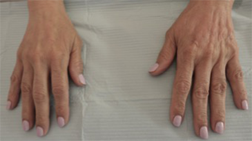 Dermal Fillers (Hand) Patient