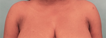 Liposuction Patient #10 After Photo # 2