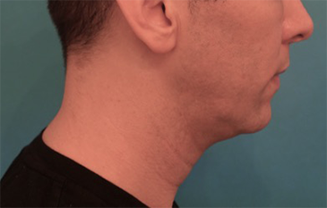Before Image: Kybella Patient #4 -