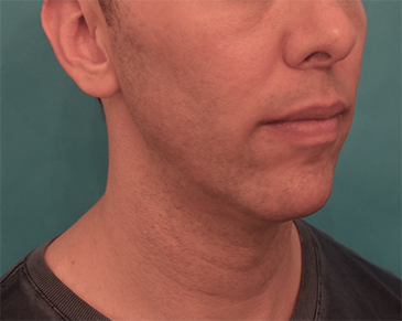 After Image: Kybella Patient #4 -