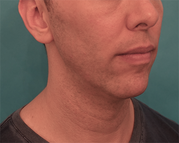 Kybella Patient #4 After Photo # 8