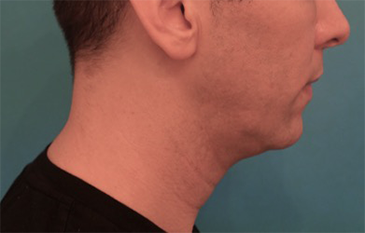 Male Kybella Patient #4 Before Photo Thumbnail # 5