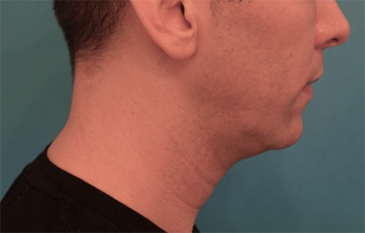 Male Kybella Patient #4 Before Photo # 5