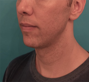 After Image: Kybella Patient #4 -