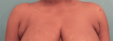 Liposuction Patient #10 Before Photo # 1