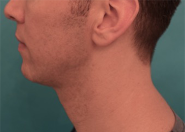 Male Kybella Patient #4 After Photo Thumbnail # 4
