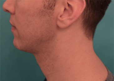 After Image: Male Kybella Patient #4 - 