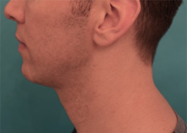 Male Kybella Patient #4 After Photo # 4