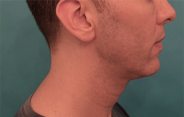 After Image: Male Kybella Patient #4 - 