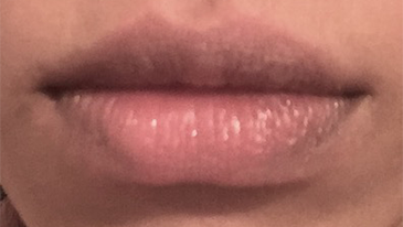 Lip Filler Patient #9 After Photo Thumbnail # 2
