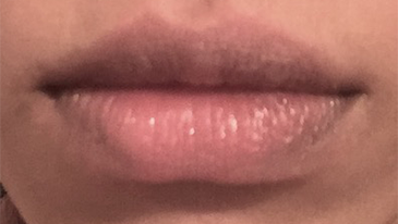 Lip Filler Patient #9 After Photo # 2