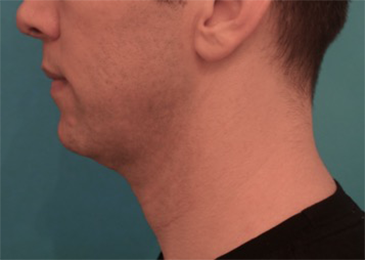Male Kybella Patient #4 Before Photo # 3
