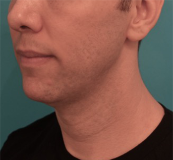 Before Image: Male Kybella Patient #4 - 