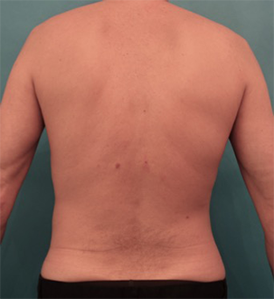 Liposuction Patient #9 After Photo # 2