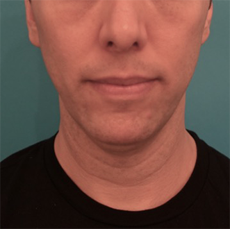 Male Kybella Patient #4 Before Photo # 1