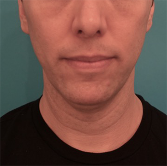 Male Kybella Patient