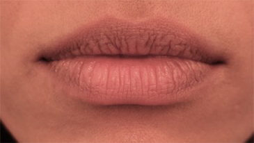 Lip Filler Patient