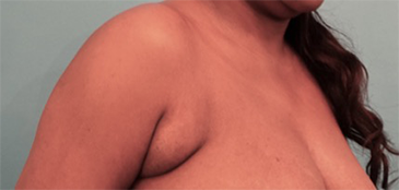 Liposuction Patient #10 Before Photo # 5