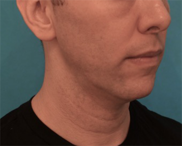 Before Image: Kybella Patient #4 -