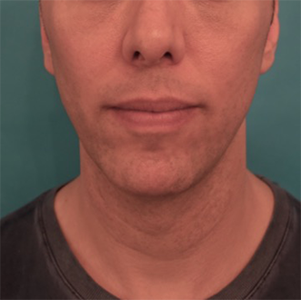 Male Kybella Patient #4 After Photo Thumbnail # 2