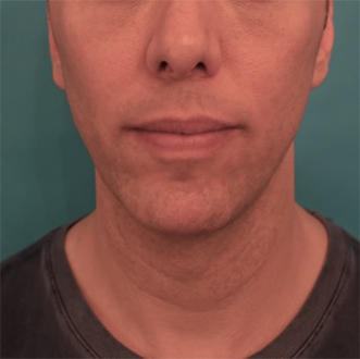 After Image: Male Kybella Patient #4 - 