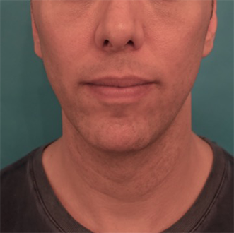 Male Kybella Patient