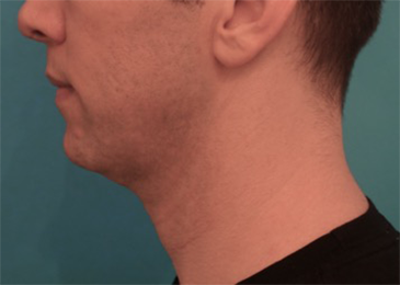 Before Image: Kybella Patient #4 -
